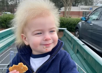 Menino com ‘síndrome do cabelo impenteável’ faz sucesso nas redes sociais; veja fotos